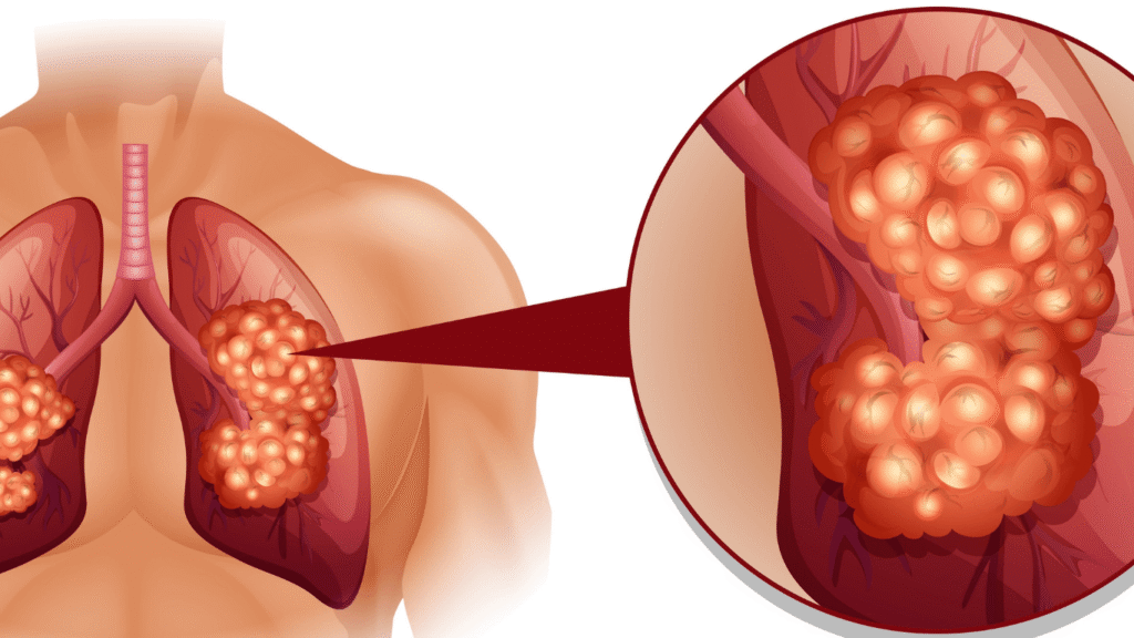 respiratory diseases-satwa ayurvedic clinic palakkad